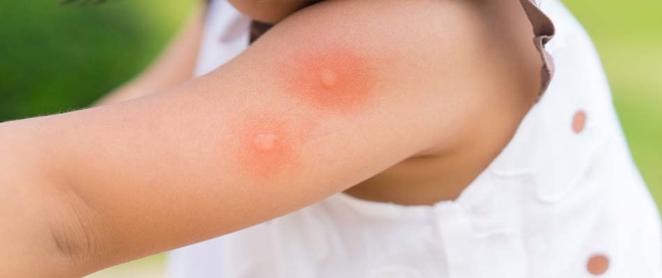 Mosquito bites on a child's arm near Zionsville, ID.